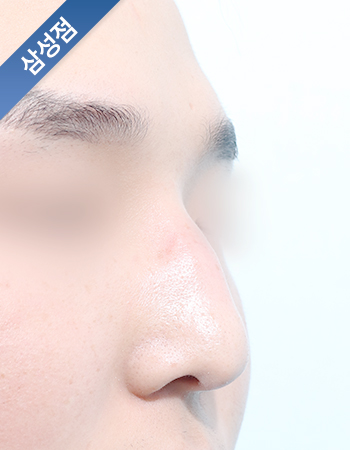 코성형 전후사진