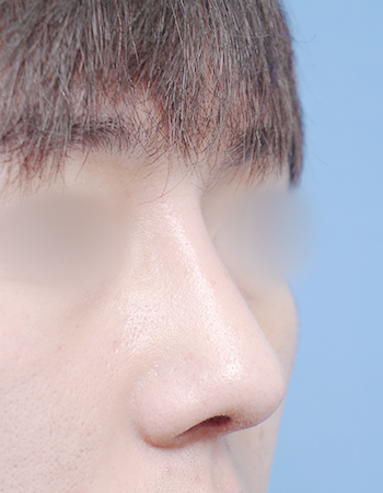 코성형 전후사진