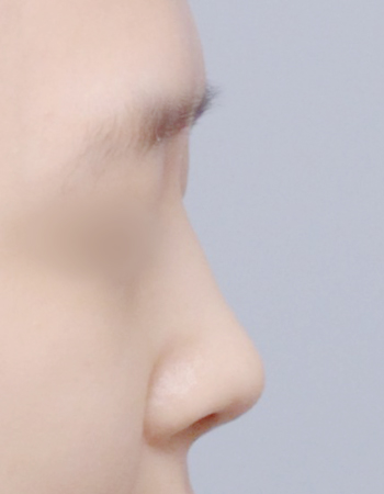 코성형 전후사진