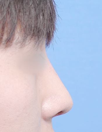 코성형 전후사진