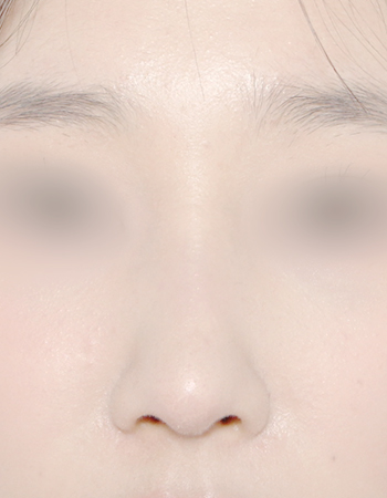 코성형 전후사진