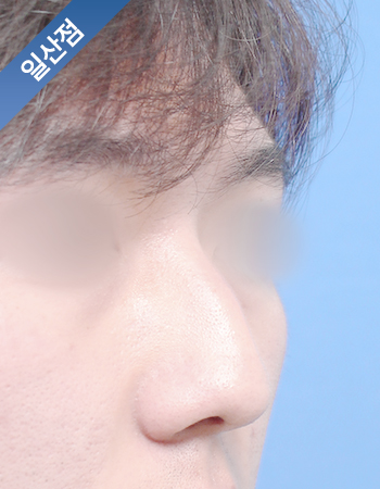 코성형 전후사진