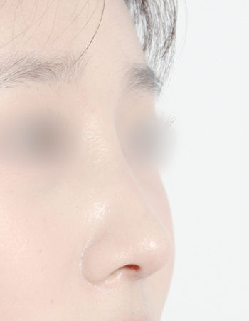 코성형 전후사진