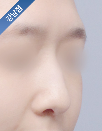 코성형 전후사진