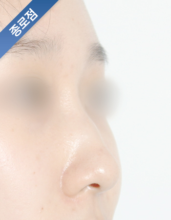 코성형 전후사진