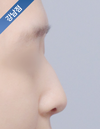 코성형 전후사진