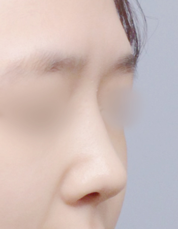 코성형 전후사진