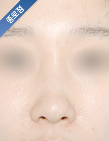 코성형 전후사진