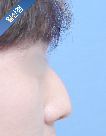 코성형 전후사진