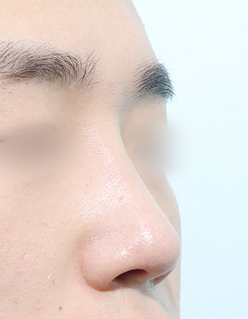 코성형 전후사진