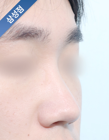 코성형 전후사진