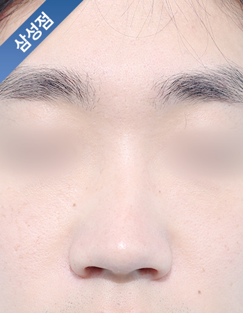 코성형 전후사진