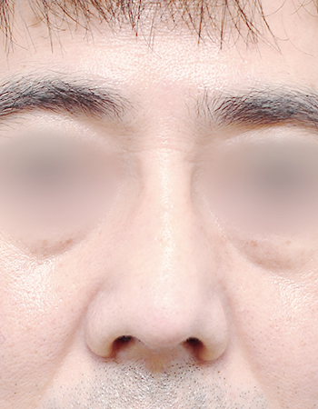 코성형 전후사진