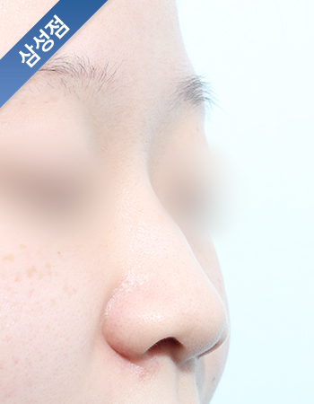 코성형 전후사진
