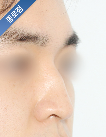 코성형 전후사진