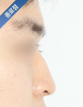코성형 전후사진