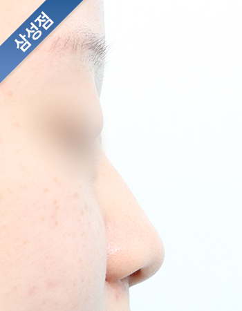 코성형 전후사진