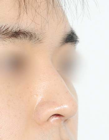 코성형 전후사진