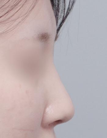 코성형 전후사진