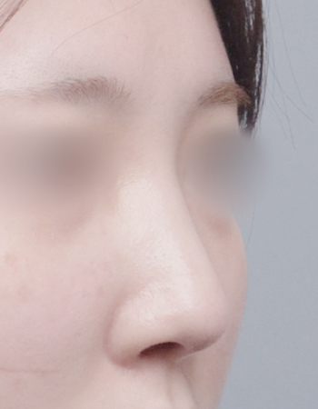 코성형 전후사진